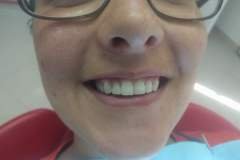 after-composite-veneer