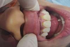 cervical-erosion-and-sensitivity-on-front-upper-two-teeth