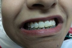 discoloured-teeth