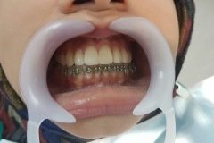 natural-looking-veneersday-of-insertion