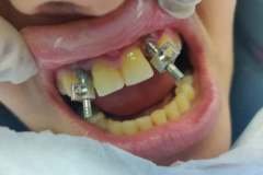 open-tray-impression-coping-showing-bad-angulation-.implant-placed-elsewhere
