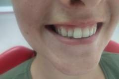 palatally-placed-lateral-incisor-refused-ortho-refused-any-tooth-preparation