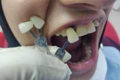 patient-referred-for-prosthetic-management-of-unfavourably-placed-implant-in-12-22